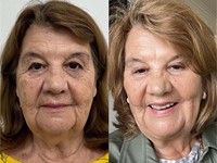 Armonización Facial en Clínica FEMME: La Ciencia al Servicio de tu Belleza Natural